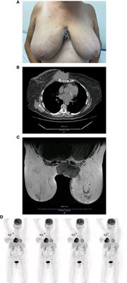 Case report: Primary CDK4/6 inhibitor and endocrine therapy in locally advanced breast cancer and its effect on gut and intratumoral microbiota